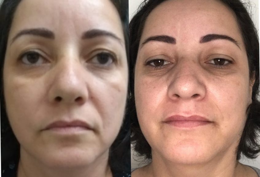 Intradermopressurizada, antes e depois